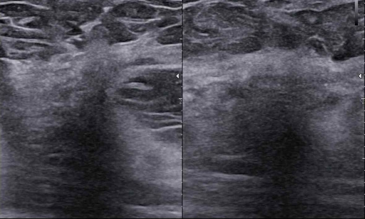 Czy podział BIRADS 4 ma sens? Jak radzić sobie  z BIRADS 4a, b, c? Morfologiczne wskazówki