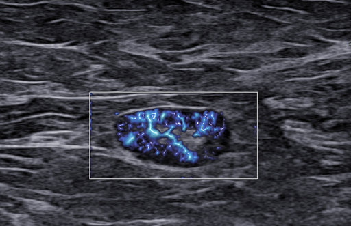 Rak piersi a obraz węzłów chłonnych. LN-RADS - część 2
